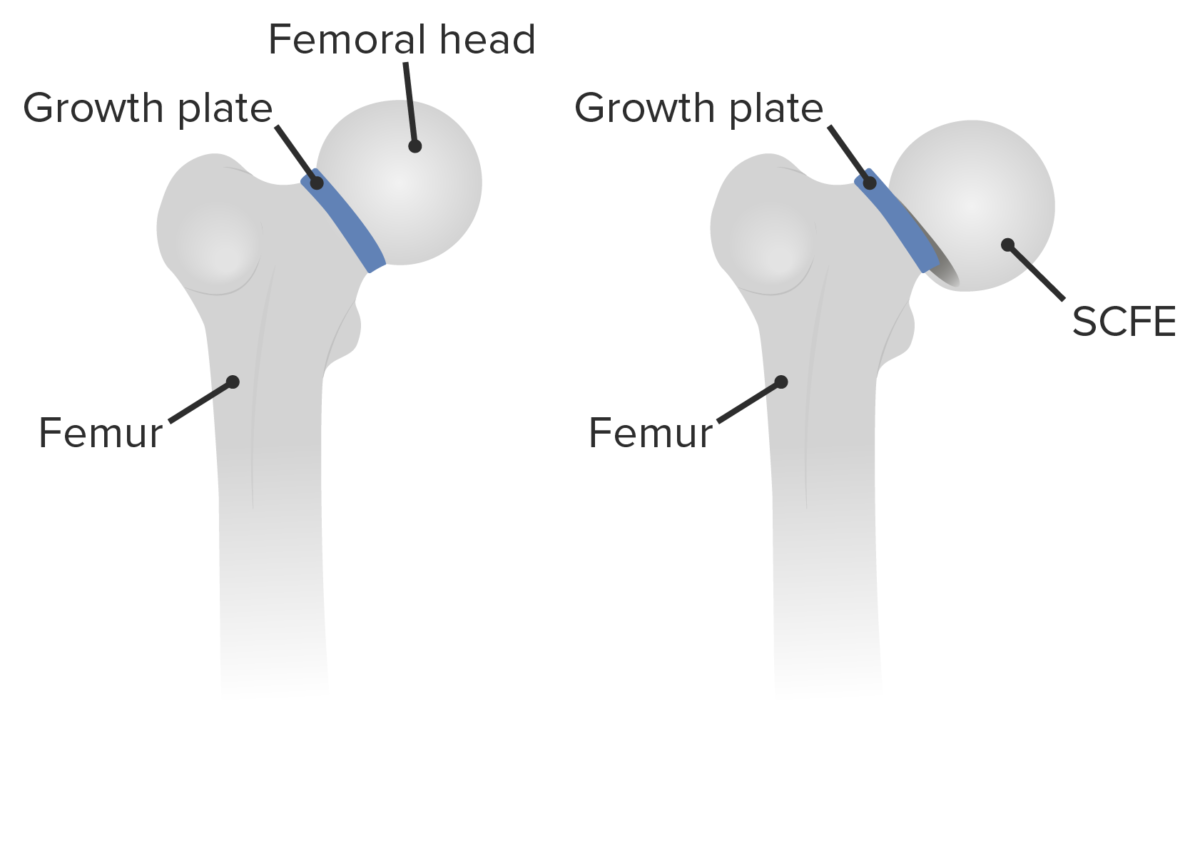 Deslizamiento epifisario de la cabeza femoral