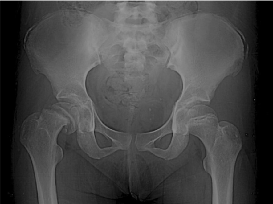 slipped capital femoral epiphysis vs legg calve perthes disease