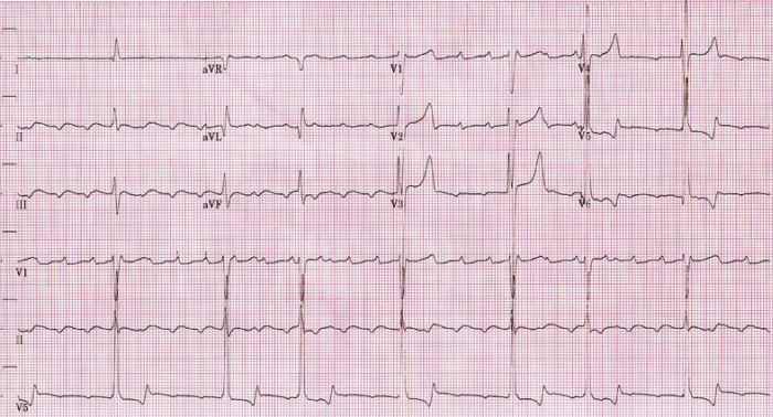 atrial flutter symptoms sweating