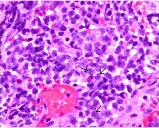 Small-cell lung carcinoma