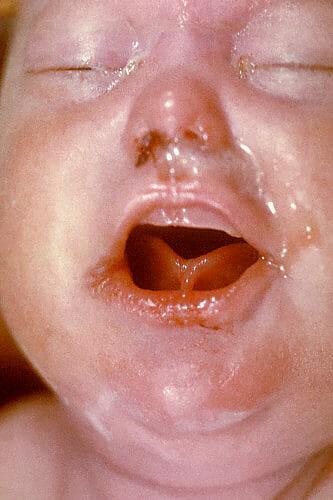 Snuffles indicating congenital syphilis