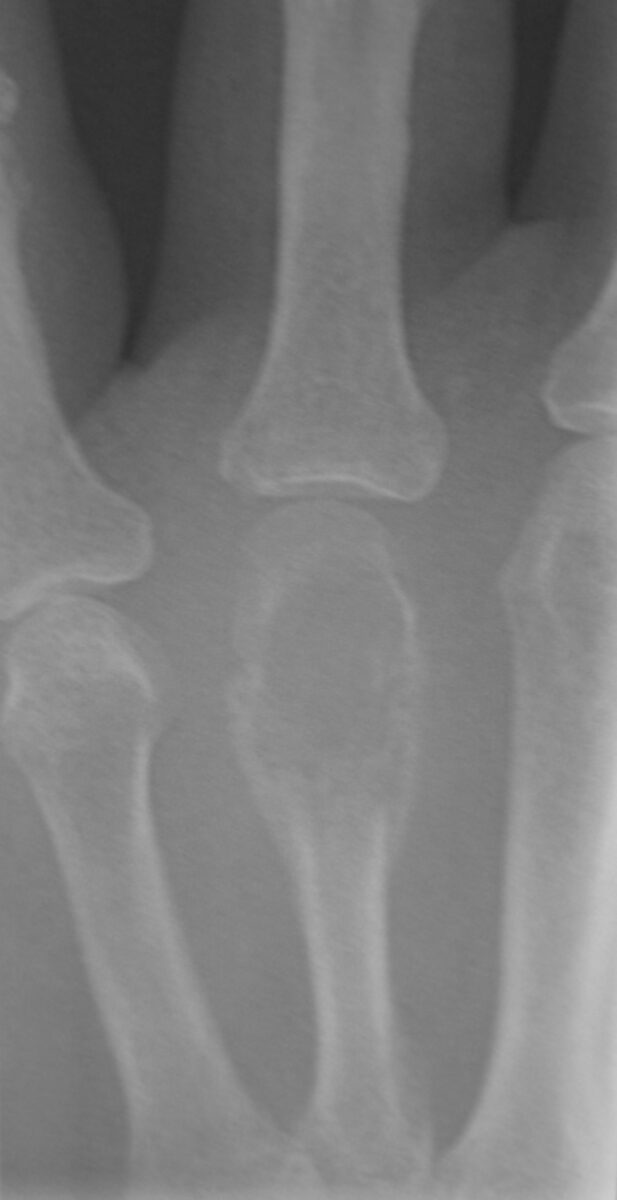 “soap bubble” appearance of a giant-cell tumor in 4th metatarsal