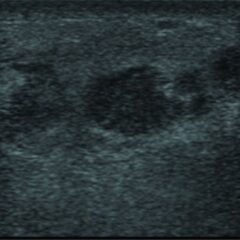 Soft tissue abscess on ultrasound