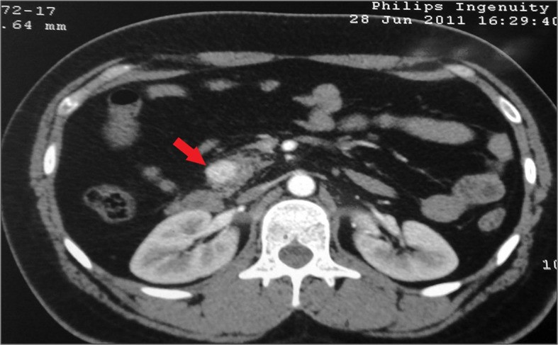Solitary insulinoma in the head of the pancreas ct