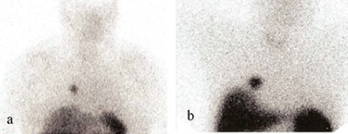 Somatostatin receptor scintigraphy of pulmonary carcinoids