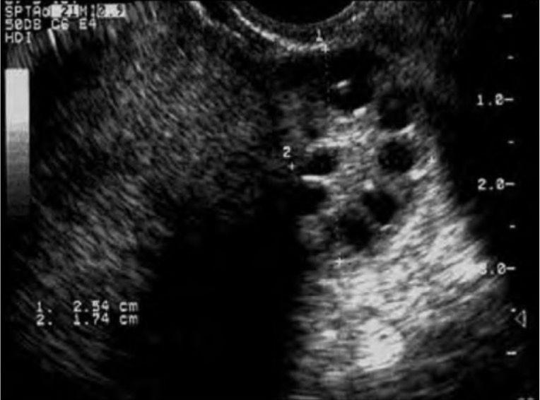 ovarian yolk sac tumor ultrasound