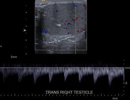 Spectral doppler ultrasound of the right testicle
