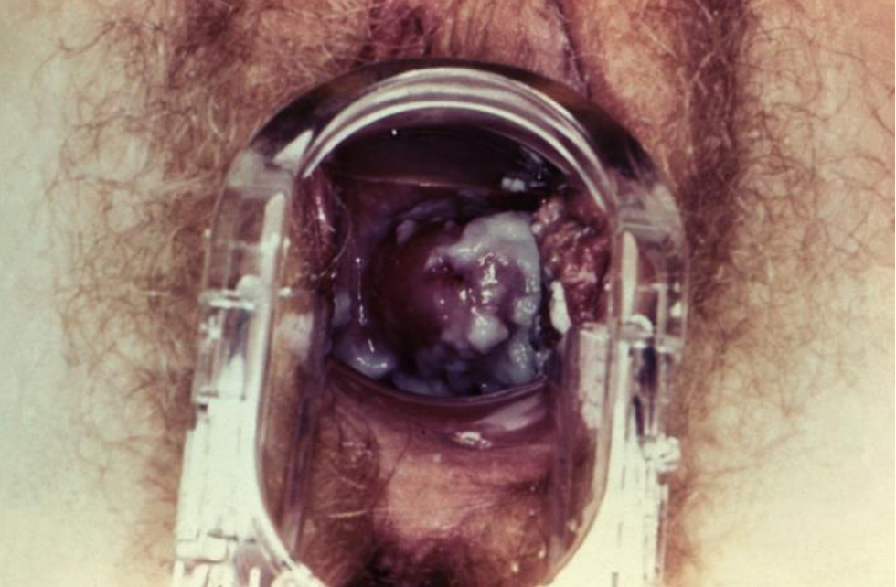Speculum examination of a patient presenting with vaginal candidiasis
