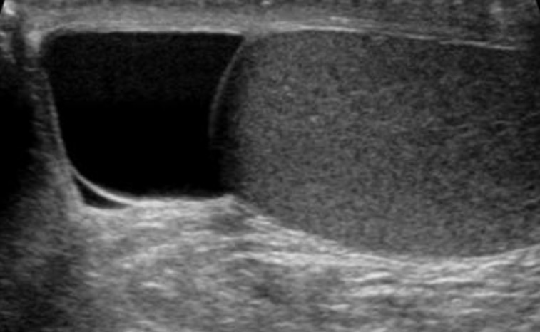 Varicocele, Hydrocele, and Spermatocele