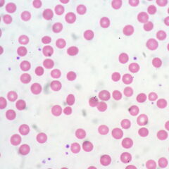 Spherocytes anemia