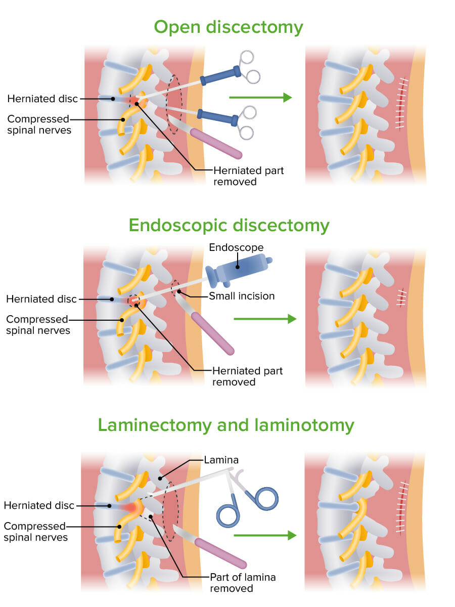 Spinal cord decompression surgery
