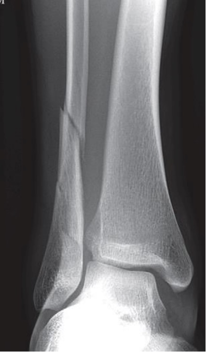 simple spiral fracture