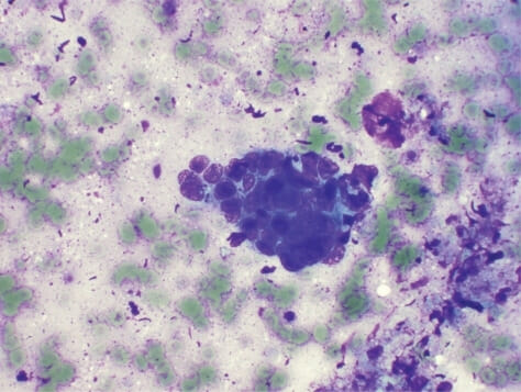 Squamous cell carcinoma of the anal canal