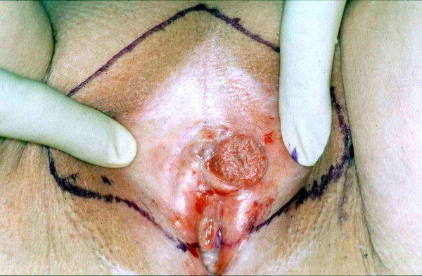 Carcinoma de células escamosas de la vulva
