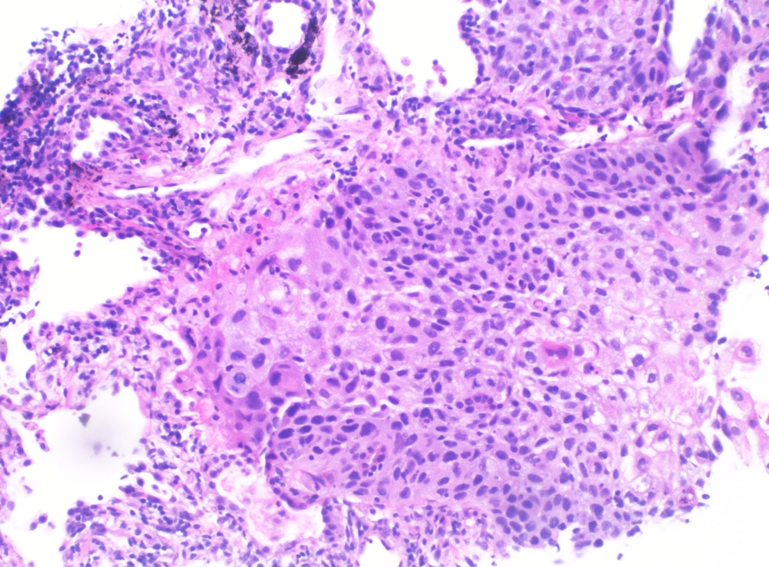 Squamous cell carcinoma on lung biopsy