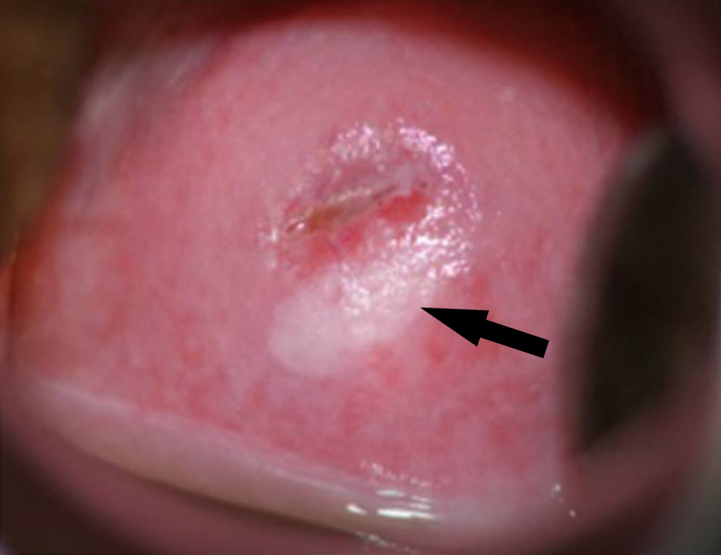 Squamous intraepithelial lesion of the cervix on colposcopy