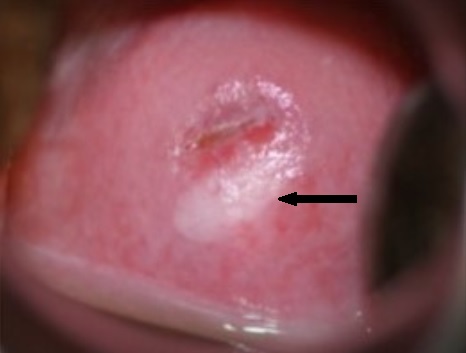 Squamous intraepithelial lesion of the cervix papillomaviridae