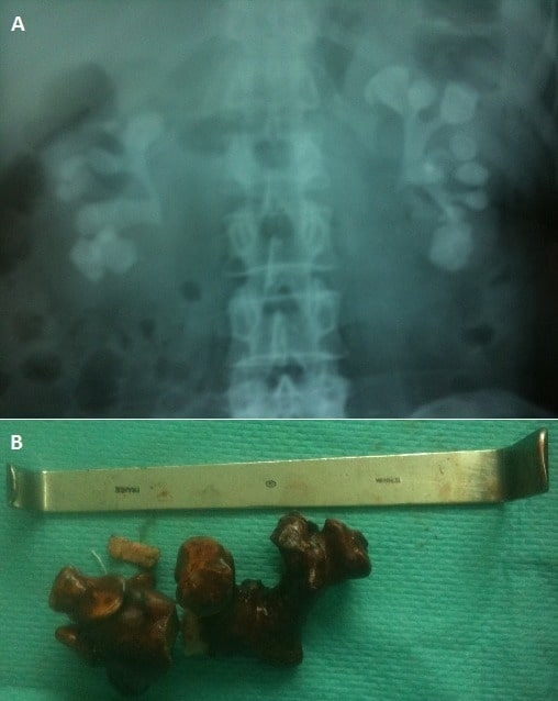 Staghorn calculi from proteus infection