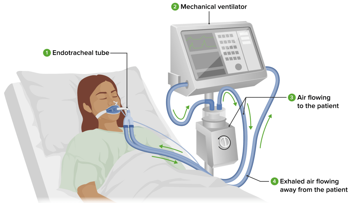 Standard ventilator setup