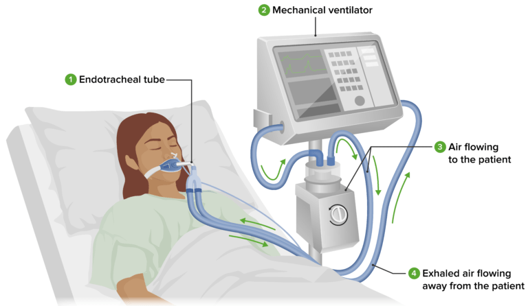 ventila-o-mec-nica-invasiva-concise-medical-knowledge