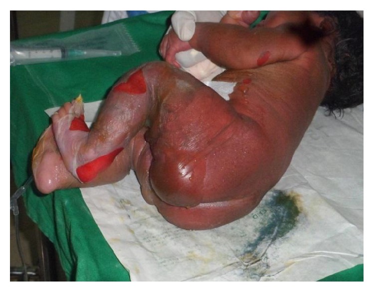 Staphylococcal scalded skin syndrome in a newborn