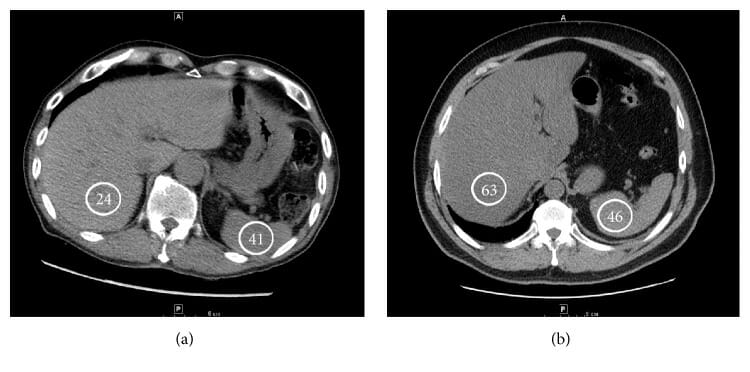 Steatotic liver (a) and normal hepatic attenuation (b)