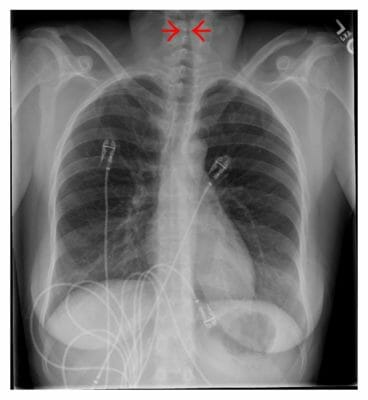 Pediatric Chest Abnormalities | Concise Medical Knowledge