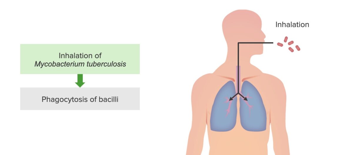 Step 1 of tuberculosis infection