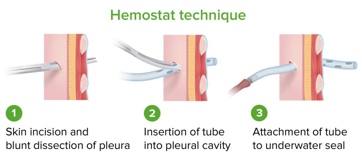 Pasos de la técnica hemostática para la colocación de tubos torácicos
