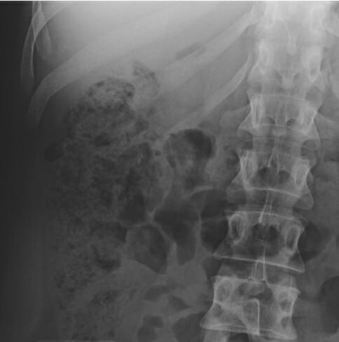 Taburete en radiografía abdominal supina