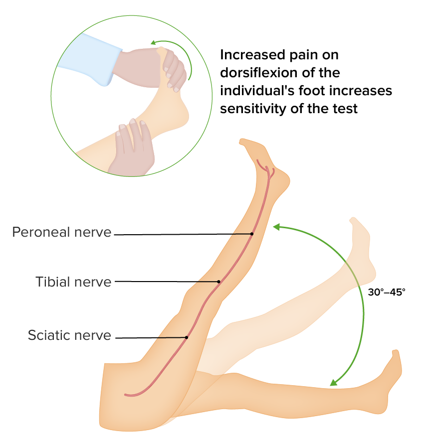 Spinal Disk Herniation Concise Medical Knowledge