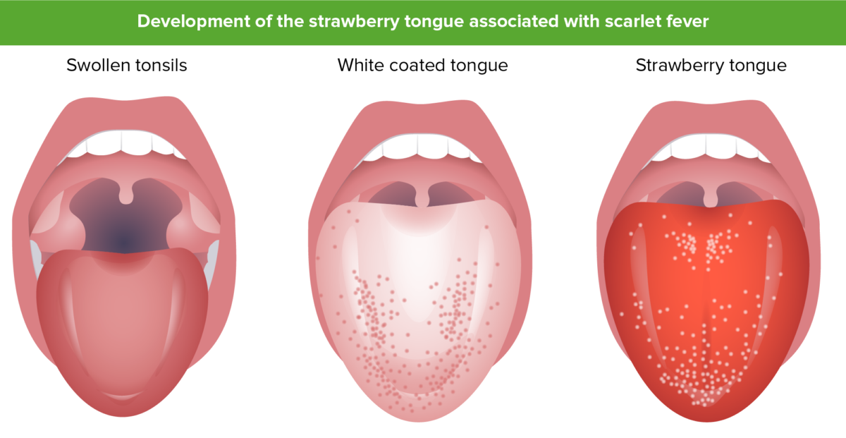 Strawberry tongue and scarlet fever