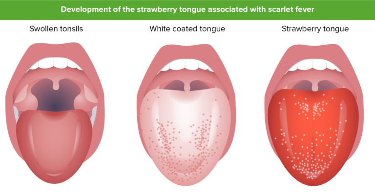 Scarlet Fever | Concise Medical Knowledge