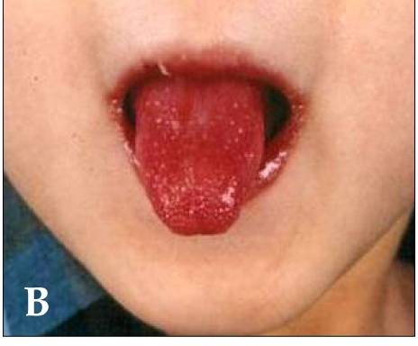 Scarlet Fever  Concise Medical Knowledge