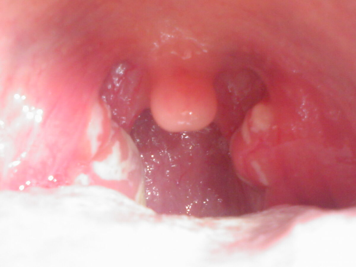 Streptococcal pharyngitis