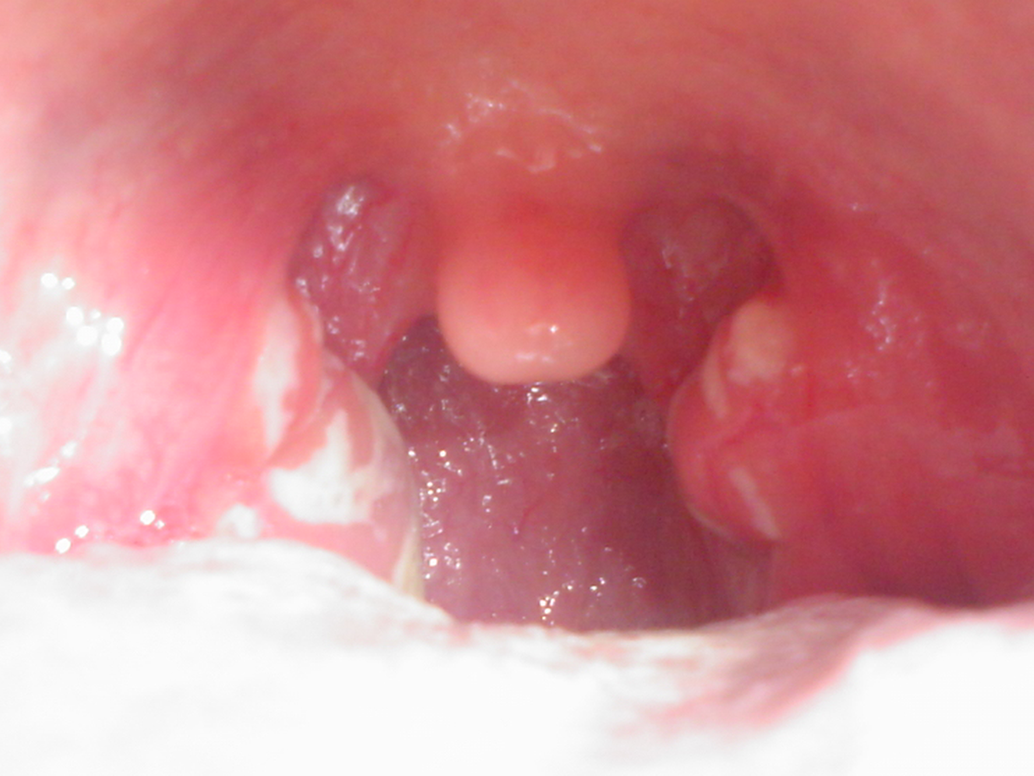 acute lymphonodular pharyngitis