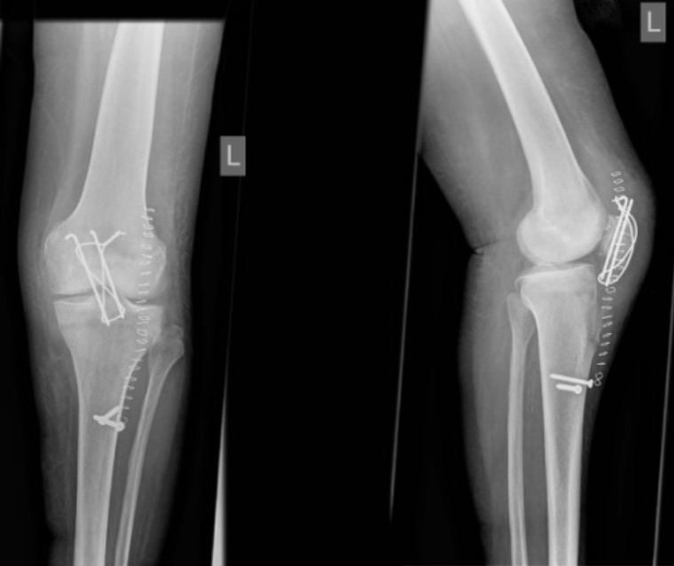 Apophyseal Avulsion Fracture | Concise Medical Knowledge