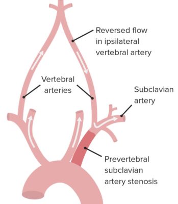 Subclavian Steal Syndrome | Concise Medical Knowledge