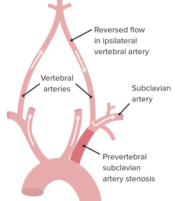 Subclavian steal
