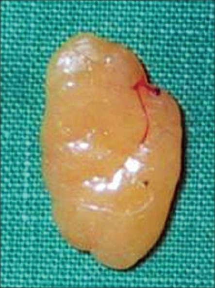 Subcutaneous lipoma 1. 5 cm