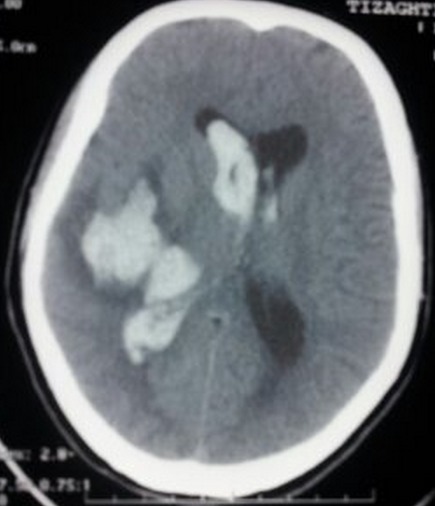 Subfalcine herniation due to hemorrhagic stroke