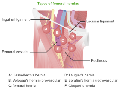 Subtypes of femoral hernias