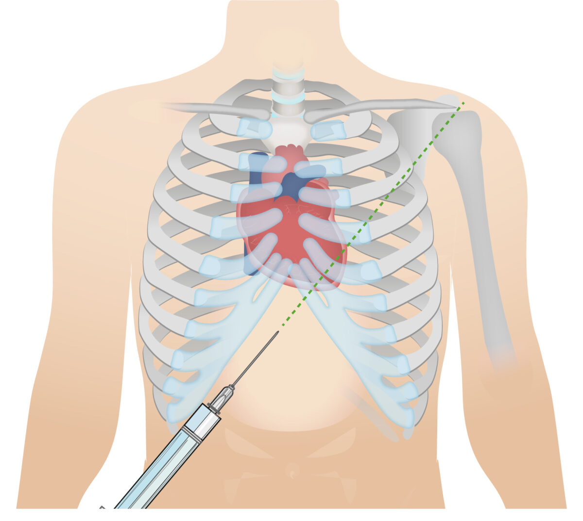 Subxiphoid approach for pericardiocentesis