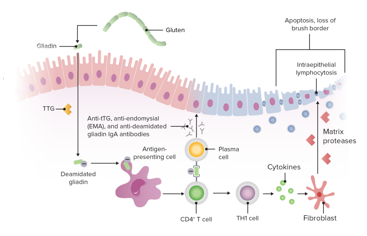 Summarizing the pathophysiology of celiac disease