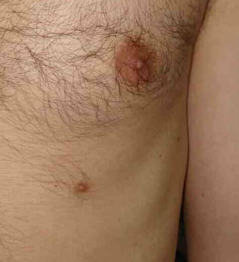 Supernumerary third nipple (male)