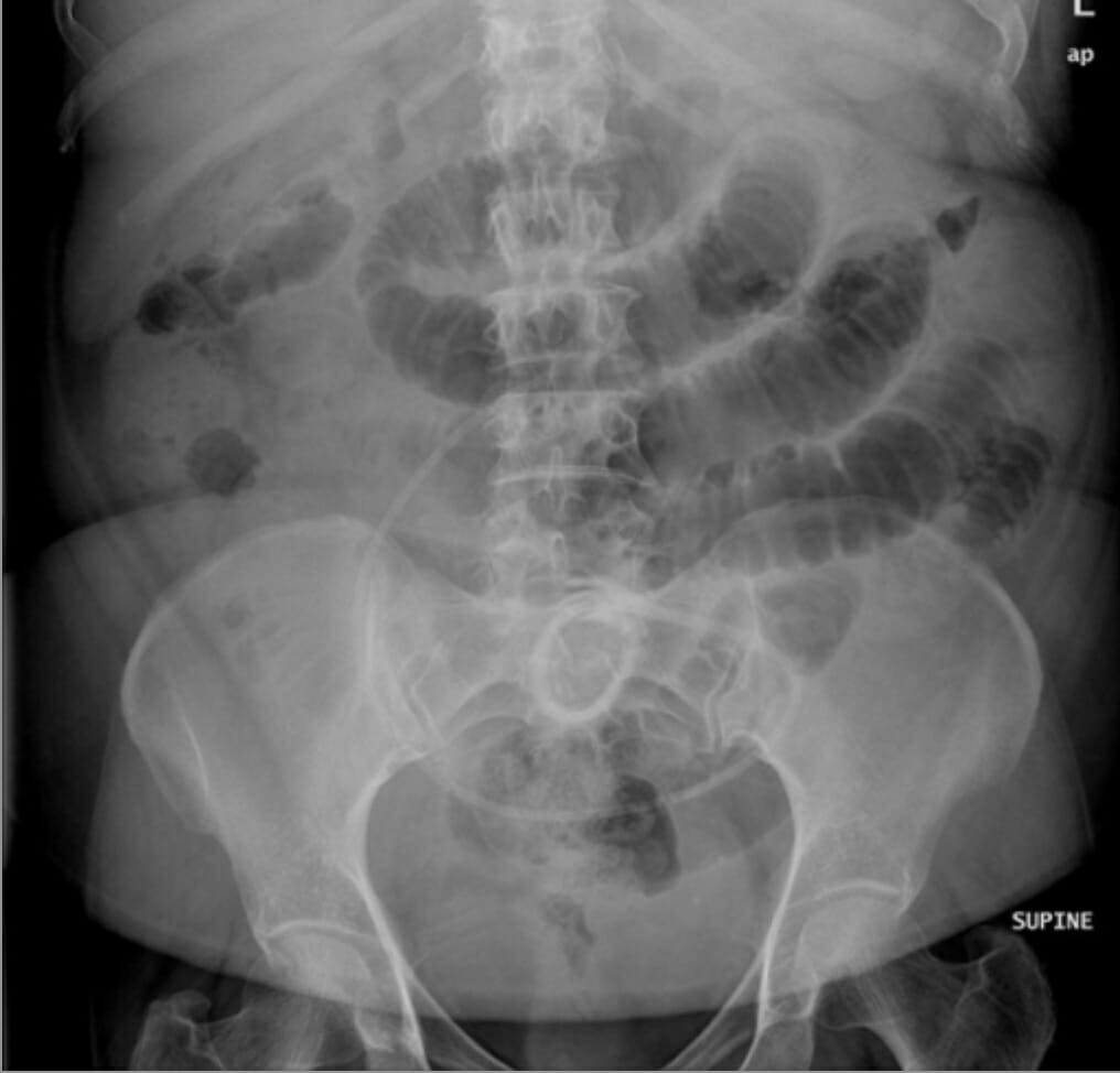 Radiografía de abdomen en decúbito supino