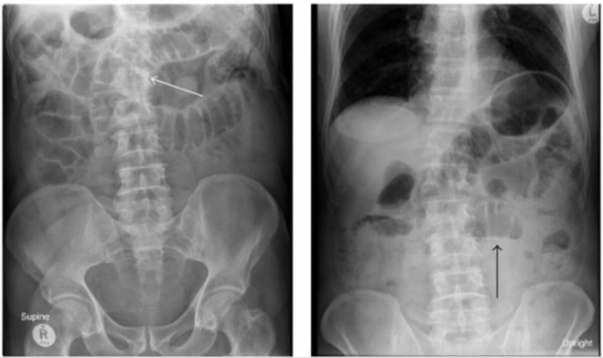 Supine and upright plain abdominal films showing distended small bowel loops