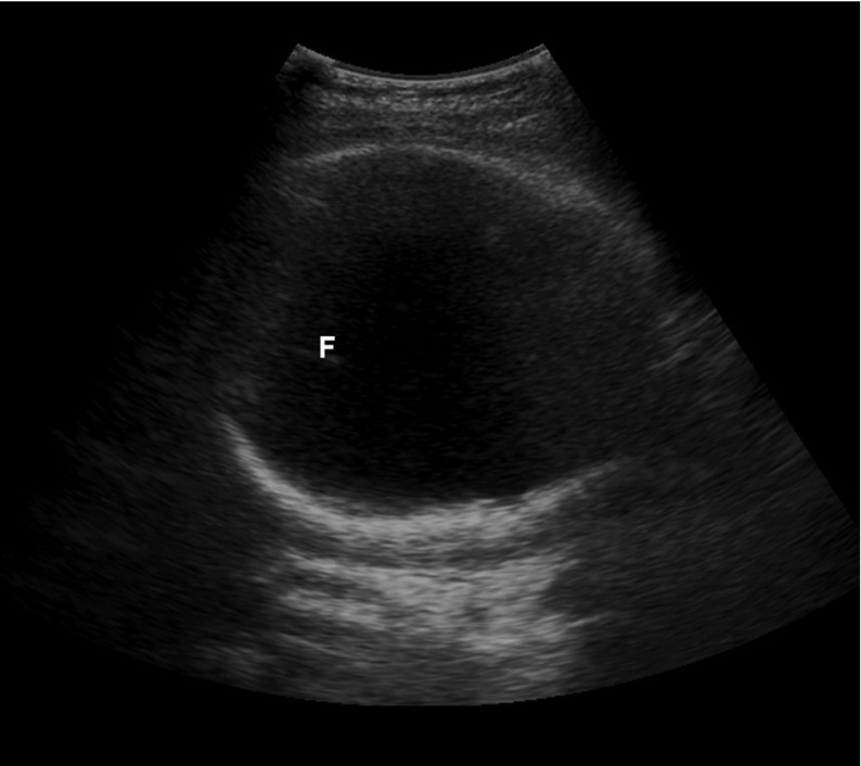 Suprapubic bedside ultrasound confirming a cephalic presentation