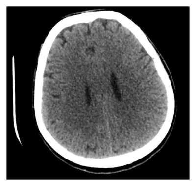 Hyponatremia | Concise Medical Knowledge