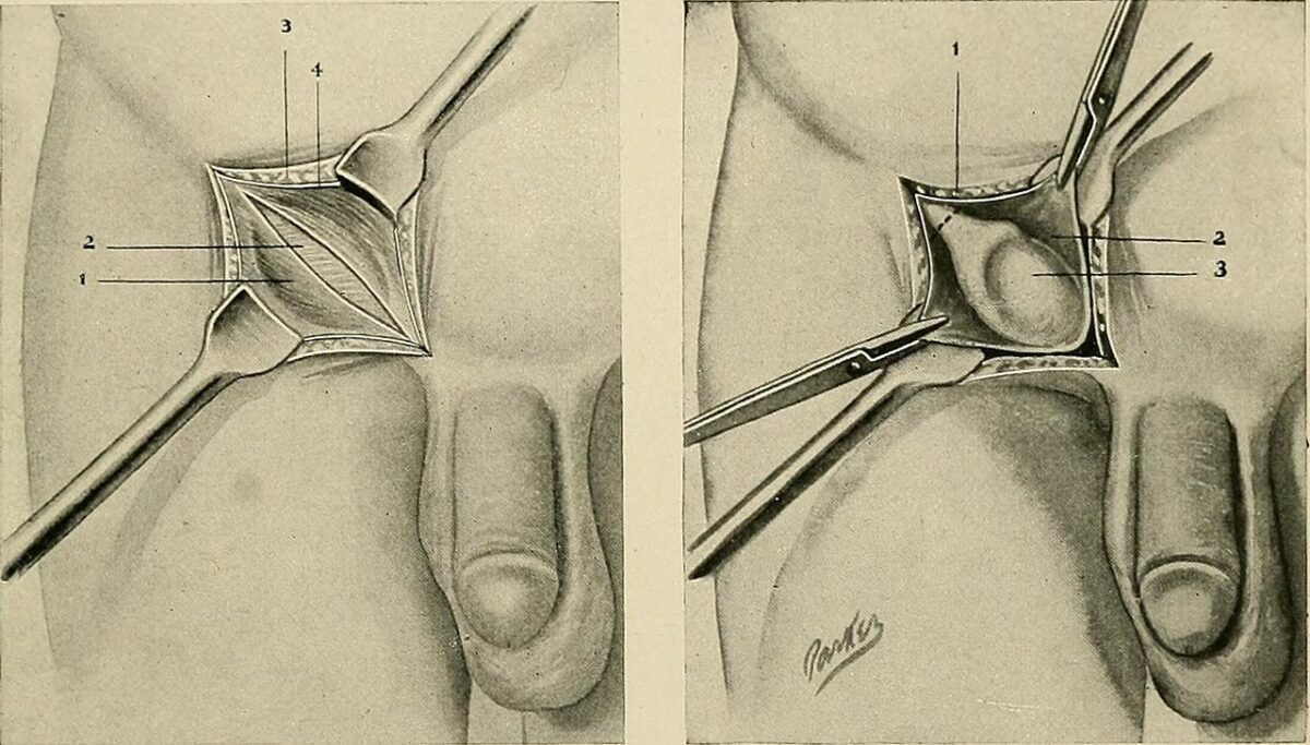 Surgery for undescended testis